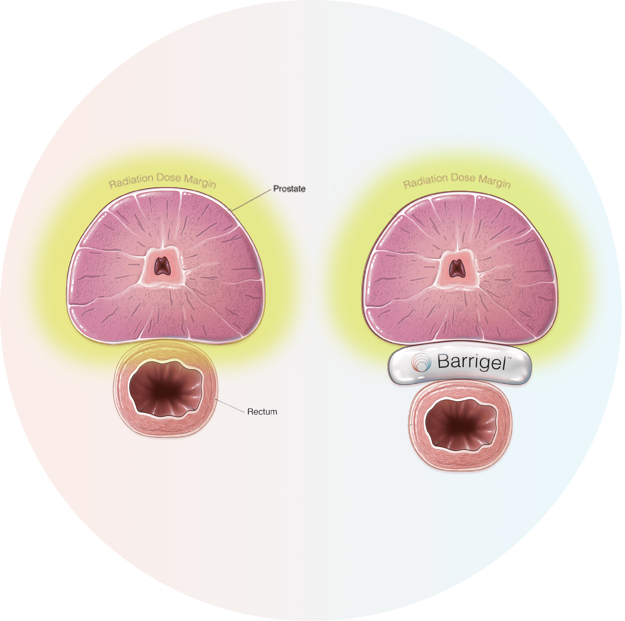 New Barrigel B&A Illustration